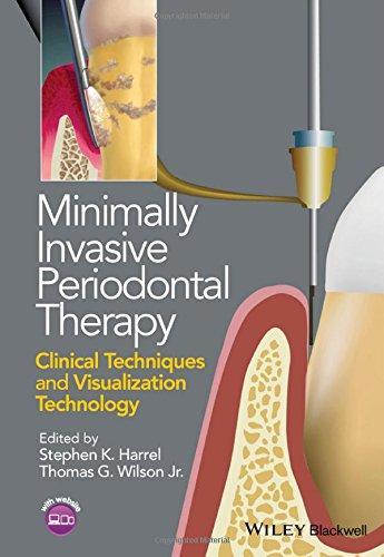 Minimally Invasive Periodontal Therapy Clinical Techniques And Visualization Technology